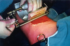 Fig. 1 - Dermotome blade regulated to maximum to remove epidermis and dermis.