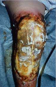 Fig. 5a - Knee and surrounding area on admission