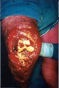 Fig. 5b - Exposure fissural and tibial condyles.