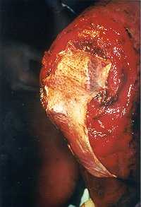 Figs. 5c - Reconstruction of articular capsule by means of dermis used as a sandwich.