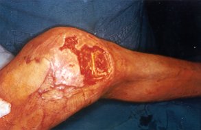 Fig. 6a - Aspect of knee area after escharectomy. The open articulation.