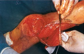 Fig. 6b - Reconstruction of capsular apparatus by means of dermis.