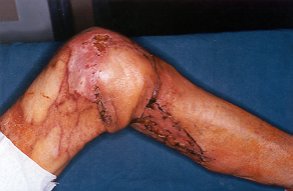 Fig. 6d - Articular excursion satisfactory