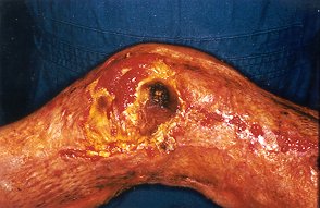 Fig. 7a - Burned area before complete escharectomy.