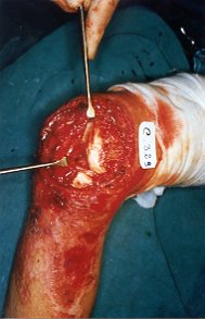 Fig. 8a - Large loss of articular capsule