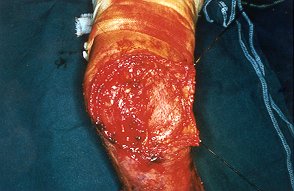 Fig. 8b - Recostruction of articular apparatus with a sheet of dermis