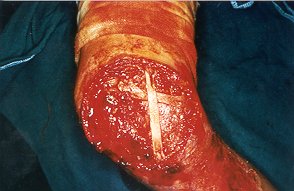 Fig. 8c - Scrips of dermis used as reinforcement