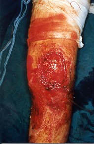 Fig. 8d - Before placing skin graft.