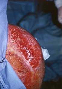 Fig. la - Aspect of wound after debridement of left shoulder.