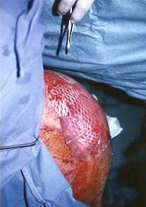 Fig. 1b - Graft performed with 3:1 meshed autograft. Only the external area is covered with film seeded with autologous keratinocytes.