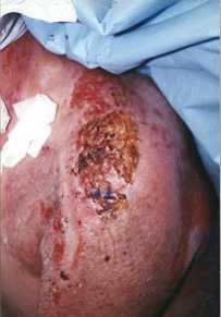 Fig. 1c - Result of graft on day 6: brown aspect of dried film partially concealing wound healing.