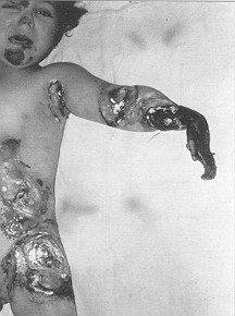 Fig. 1 - Brulure eletrique profonde d'un enfant