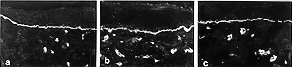 Fig. 3 - Laminin synthesis after homogeneous and heterologous epidermal substitute grafting. Biopsy samples were taken 14 days post-grafting and stained with anti-laminin monoclonal antibody. This staining showed linear deposition of immunoreactants along the dermo-epidermal J . unction after 50-50% (b) and 25-75% (c) heterologous implant grafting. Results were comparable to those obtained after homogeneous (a) implant grafting. The same results were obtained 30 days post-grafting. Magnification: X 200.