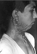 Fig. la - Case 1: Neck contraclure