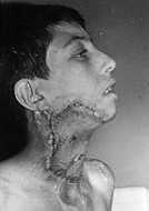 Fig. Ib - Case 1: Released by skin graft.