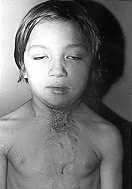 Fig. 2b - Case 2: Late result after 6 months.