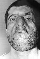 Fig. 3a - Case 3: Severely burned face with microstomia
