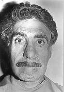 Fig. 4a - Case 4: Ectropion of lower eyelid