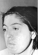 Fig. 5a - Case 5: Irregular scars