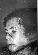 Fig. 6c - Case 6: Nasal dorsum