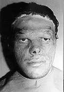Fig. 7a - Case 7: Severely deformed face.