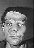 Fig. 7b - Case : dorsum of nose and bilateral cheeks reconstructed 5 months later.