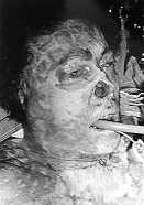 Fig. 8a - Case 8: Severely burned face.