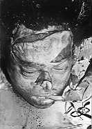 Fig. 8b - Case 8: Lower part of nose reconstructed.