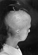 Fig. 9a - Case 9: Alopecia in right half of scalp with total ear loss.