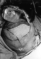 Fig. 9b - Case 9: Left parietal scalp expanded to restore alopecic right parietotemporal region; this alopecie area was intended to be used as a flap based on the superficial temporal fascia for eat reconstruction.