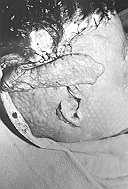 Fig. 9c - Case 9: Left parietal scalp expanded to restore alopecic right parictotemporal region; this alopecic area was intended to be used as a flap based on the superficial temporal fascia for ear reconstruction.