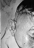 Fig. 9d - Case 9: Ear reconstruction achieved by costal cartilage frame covered by temporal fasciocutaneous flap.