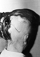 Fig. 9e - Case 9: Late result after one year.