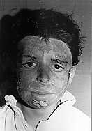Fig. 10b - Case 10: Eyebrow reconstruction by complete scalp grafts.