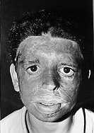 Fig. 10a - Case 10: Face burn as a result of flame.