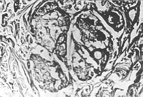 Fig. 1 - NaOH. Gravely dystrophic and necrobiotic changes in all tissue cels in the epidermic and dermal layers