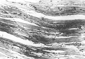 Fig. 2 - H2SO4. Distrophic changes in epidermal layer and granular formations, wavy line of collagenous fascicles, hyperaemia