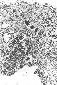 Fig. 3 - NaOH. In addition to the main changes at the 6th hour there is also epidermial inflammation. There are many macrophages among the inflamed cells.