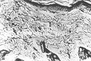 Fig. 4 - H2SO4. Dystrpphic and necrobiotic changes in the cells. Inflammation and subdermal oedema. Inflammation infiltrates of histiocyte and macrophage character.