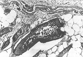 Fig. 6 - NaOH. Initial proliferation of young granulated tissues.