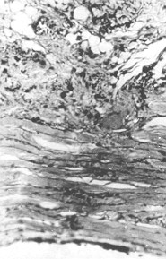 Fig. 7 - NaOH. Granulation tissue with expressed fibrogenesis under the scar