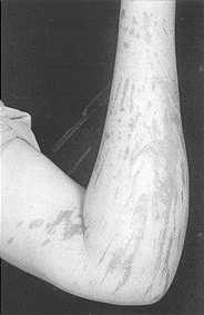 Fig. 4 - After removal of tar.