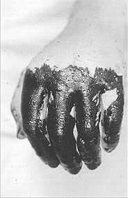Fig. 5 - Before treatment.
