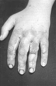 Fig. 6 - After removal of tar.
