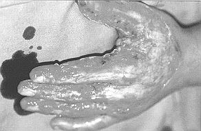 Fig. 1b - Cas clinique n' 1. Excision avec exposition