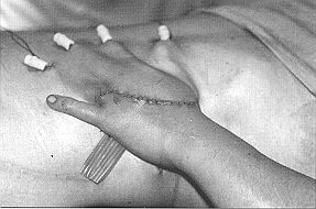 Fig. lc - Cas clinique n' 1. Couverture par