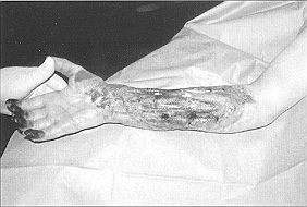 Fig. 2a - Cas clinique n' 2. Aspect après tentative