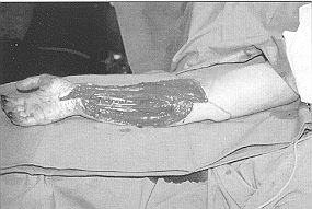 Fig. 2b - Cas clinique n' 2. Réexcision de l'ensemble