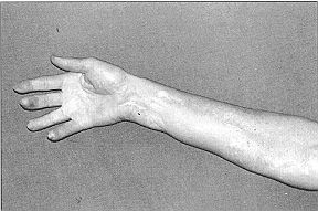 Fig. 2d - Cas clinique n' 2. Résultat à long terme après