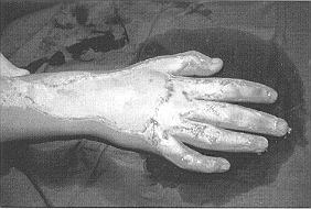 Fig. 3a - Cas clinique n' 3. Compression prolongée dans une machine à repasser; aspect pré-opératoire.